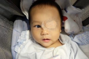 תינוק עם עין עצלה ורטיה